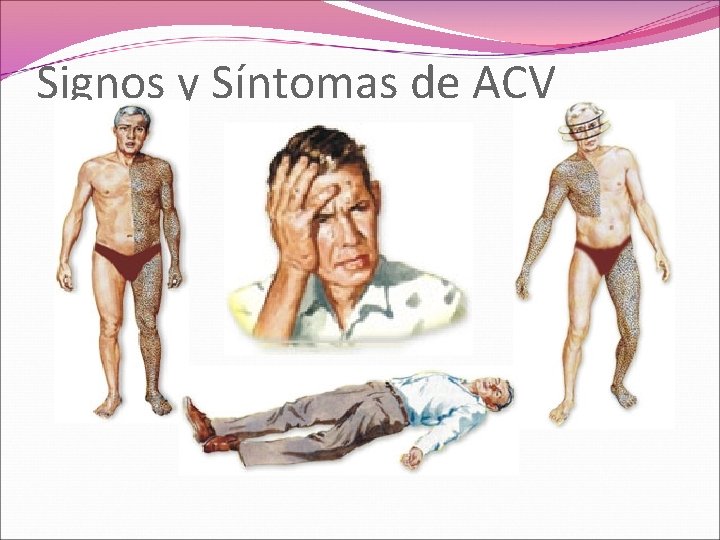 Signos y Síntomas de ACV 