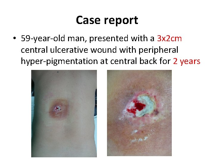 Case report • 59 -year-old man, presented with a 3 x 2 cm central