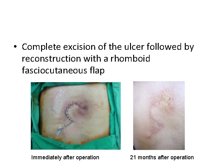  • Complete excision of the ulcer followed by reconstruction with a rhomboid fasciocutaneous