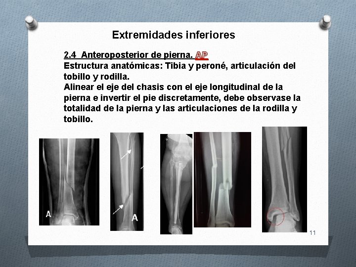 Extremidades inferiores 2. 4 Anteroposterior de pierna. AP Estructura anatómicas: Tibia y peroné, articulación