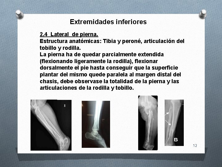 Extremidades inferiores 2. 4 Lateral de pierna. Estructura anatómicas: Tibia y peroné, articulación del