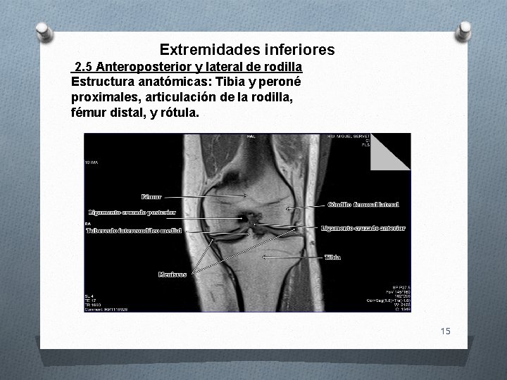 Extremidades inferiores 2. 5 Anteroposterior y lateral de rodilla Estructura anatómicas: Tibia y peroné