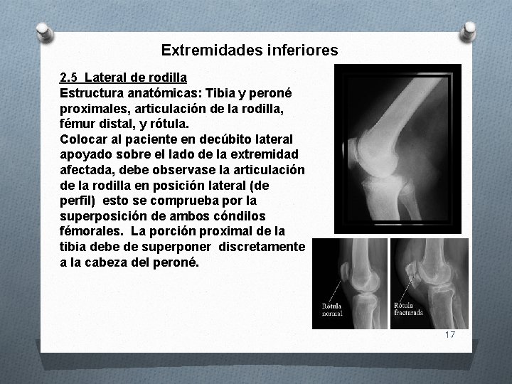 Extremidades inferiores 2. 5 Lateral de rodilla Estructura anatómicas: Tibia y peroné proximales, articulación