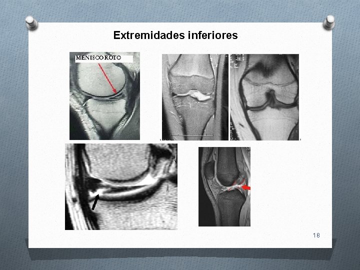 Extremidades inferiores 18 