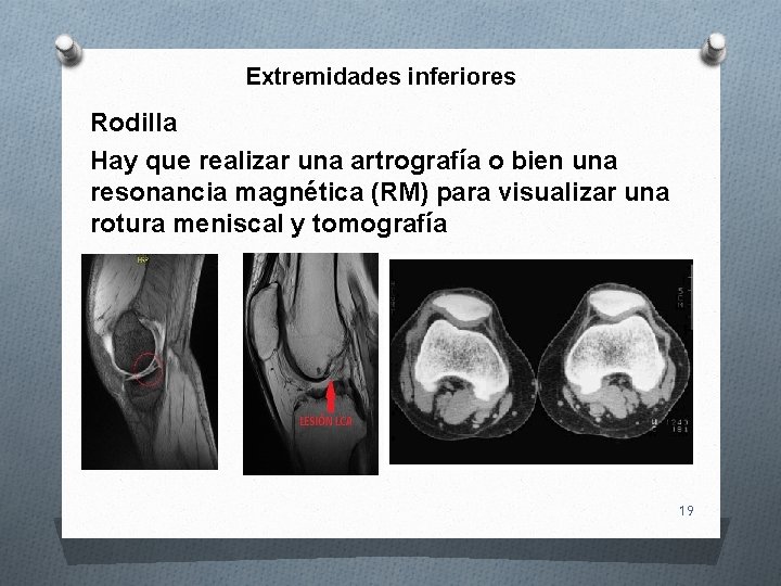 Extremidades inferiores Rodilla Hay que realizar una artrografía o bien una resonancia magnética (RM)