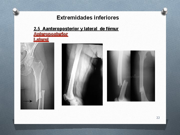 Extremidades inferiores 2. 5 Aanteroposterior y lateral de fémur Anteroposterior Lateral 22 