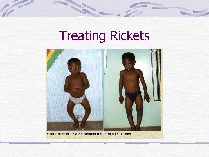 Treating Rickets 