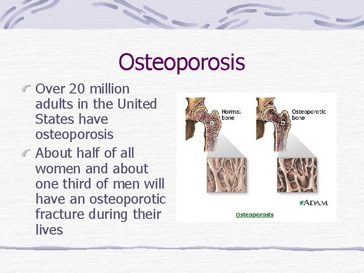 Osteoporosis Over 20 million adults in the United States have osteoporosis About half of