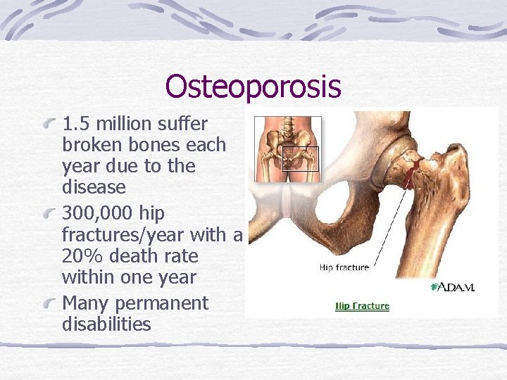 Osteoporosis 1. 5 million suffer broken bones each year due to the disease 300,