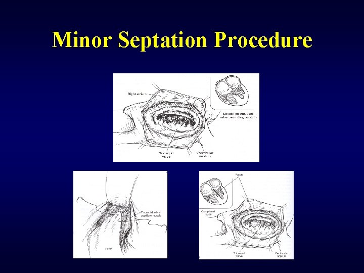 Minor Septation Procedure 