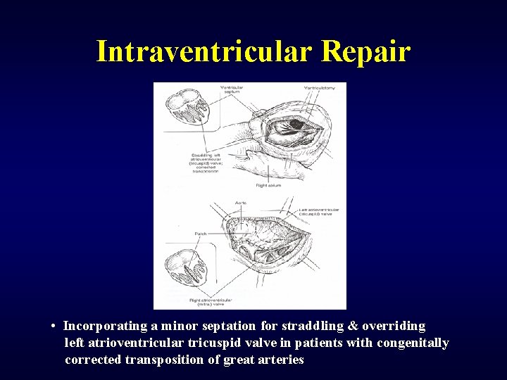 Intraventricular Repair • Incorporating a minor septation for straddling & overriding left atrioventricular tricuspid