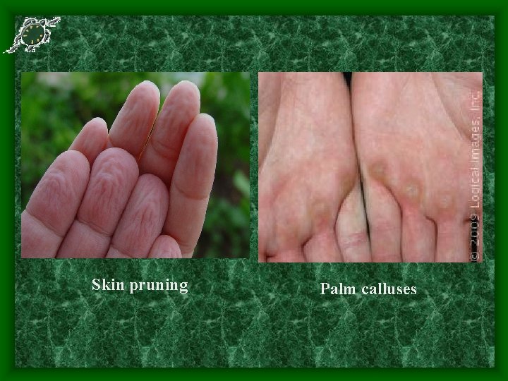 Skin pruning Palm calluses 