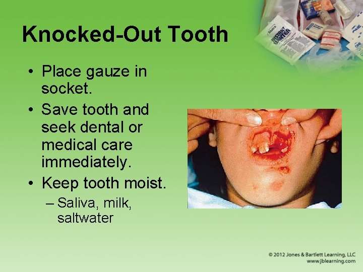 Knocked-Out Tooth • Place gauze in socket. • Save tooth and seek dental or