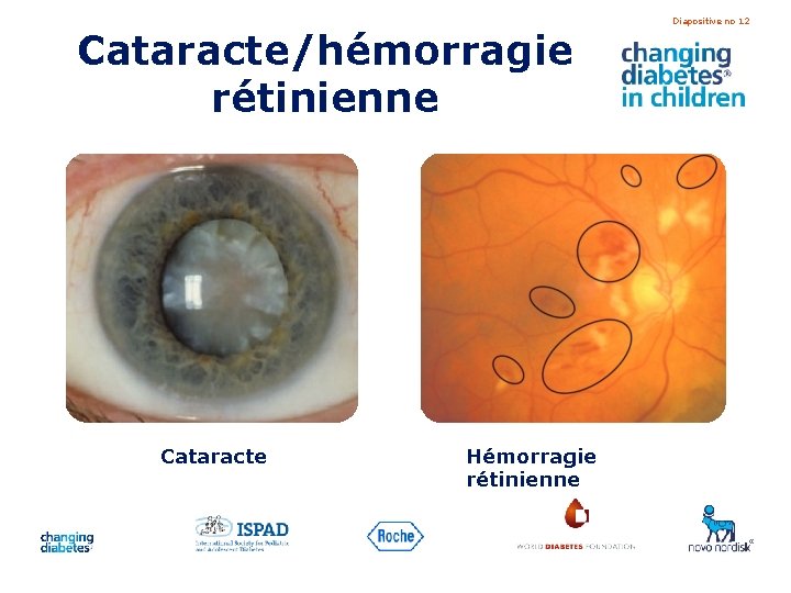 Cataracte/hémorragie rétinienne Cataracte Hémorragie rétinienne Diapositive no 12 