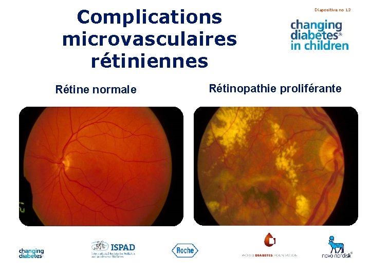 Complications microvasculaires rétiniennes Rétine normale Diapositive no 13 Rétinopathie proliférante 