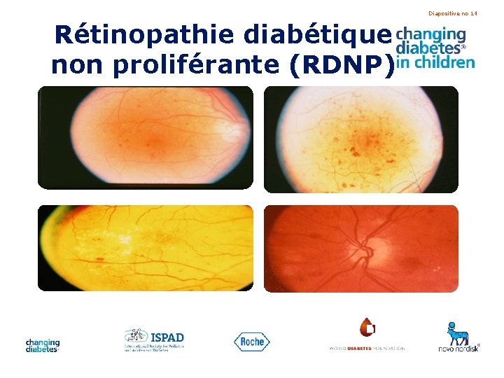 Diapositive no 14 Rétinopathie diabétique non proliférante (RDNP) 