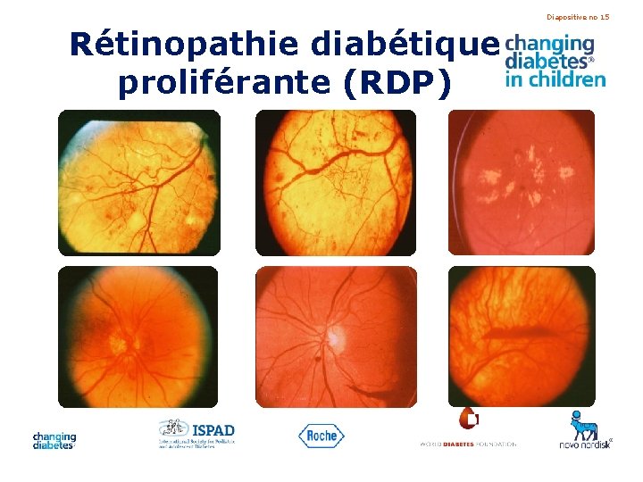 Diapositive no 15 Rétinopathie diabétique proliférante (RDP) 