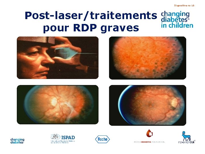 Diapositive no 16 Post-laser/traitements pour RDP graves 