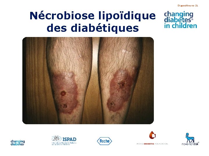 Diapositive no 21 Nécrobiose lipoïdique des diabétiques 