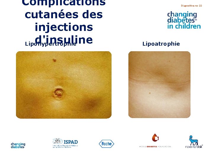 Complications cutanées des injections d'insuline Lipohypertrophie Diapositive no 22 Lipoatrophie 