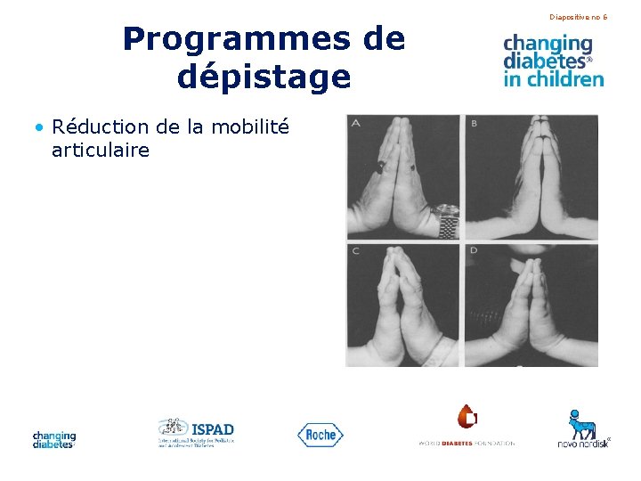 Programmes de dépistage • Réduction de la mobilité articulaire Diapositive no 6 