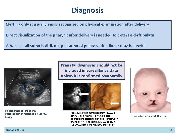 Diagnosis Cleft lip only is usually easily recognized on physical examination after delivery Direct