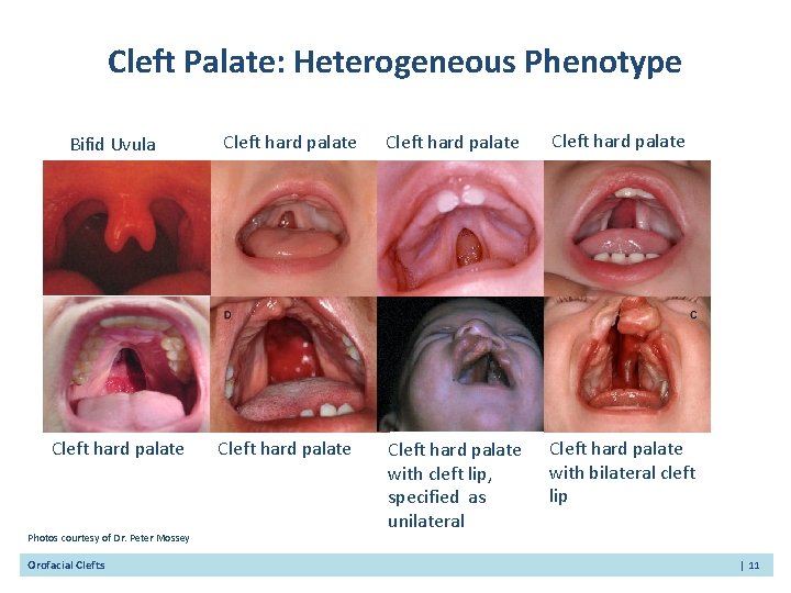 Cleft Palate: Heterogeneous Phenotype Bifid Uvula Cleft hard palate Cleft hard palate with cleft