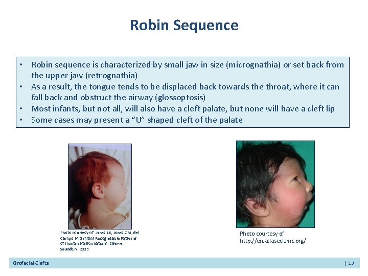 Robin Sequence • Robin sequence is characterized by small jaw in size (micrognathia) or