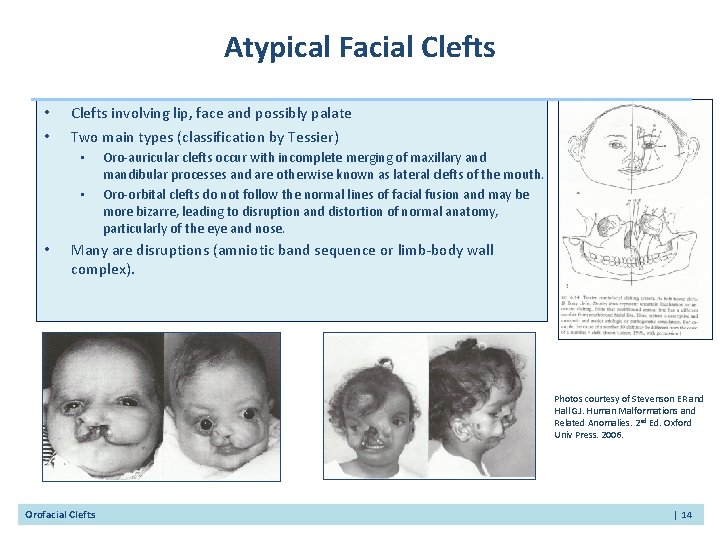Atypical Facial Clefts • • Clefts involving lip, face and possibly palate Two main