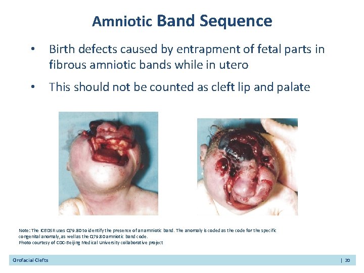 Amniotic Band Sequence • Birth defects caused by entrapment of fetal parts in fibrous