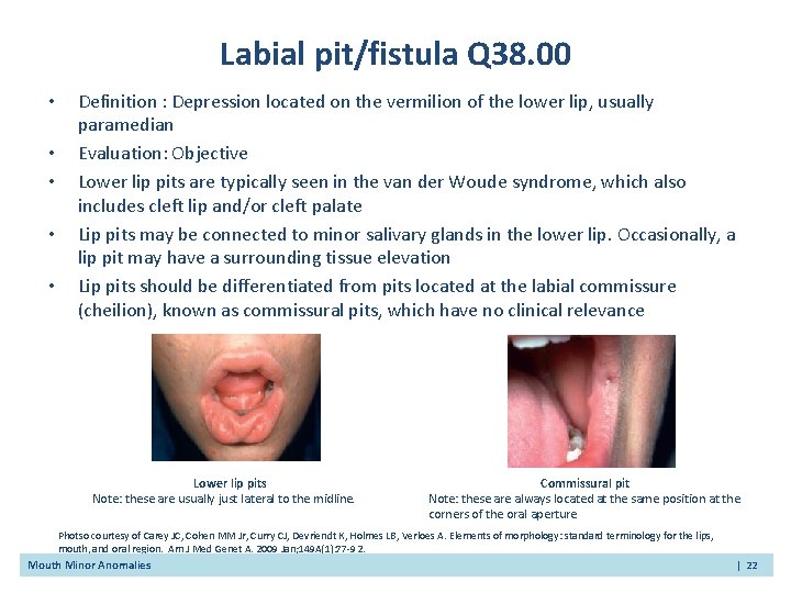 Labial pit/fistula Q 38. 00 • • • Definition : Depression located on the