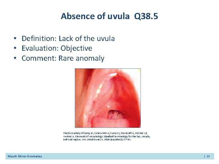 Absence of uvula Q 38. 5 • Definition: Lack of the uvula • Evaluation: