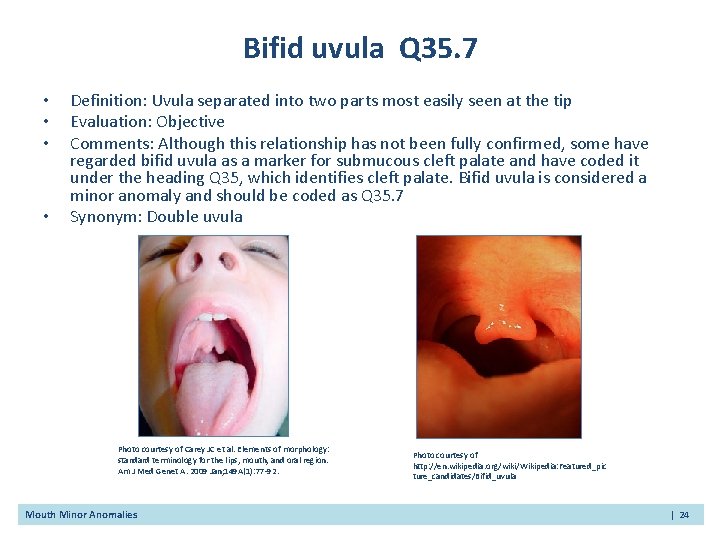 Bifid uvula Q 35. 7 • • Definition: Uvula separated into two parts most