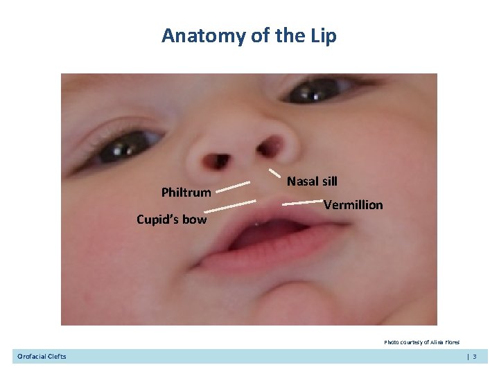 Anatomy of the Lip Philtrum Cupid’s bow Nasal sill Vermillion Photo courtesy of Alina