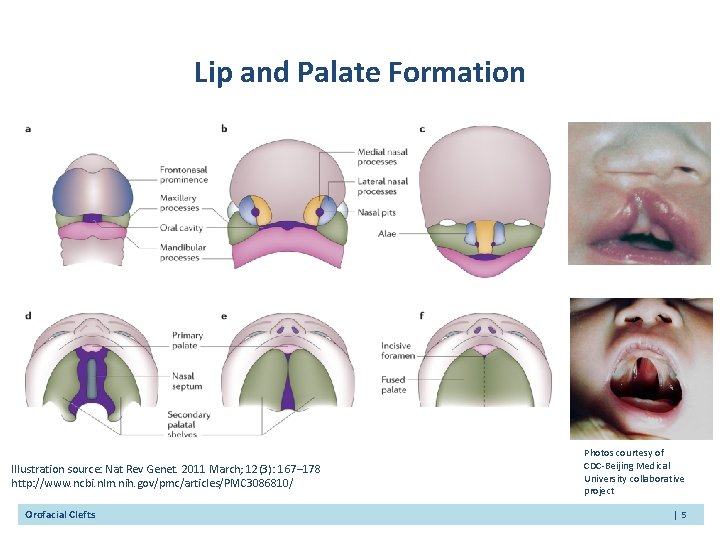 Lip and Palate Formation Illustration source: Nat Rev Genet. 2011 March; 12(3): 167– 178