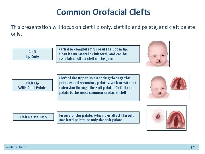 Common Orofacial Clefts This presentation will focus on cleft lip only, cleft lip and