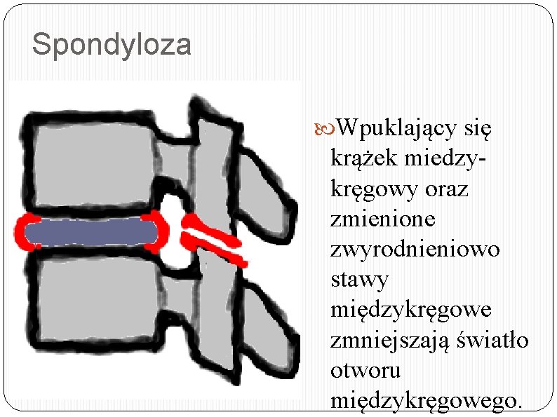 Spondyloza Wpuklający się krążek miedzykręgowy oraz zmienione zwyrodnieniowo stawy międzykręgowe zmniejszają światło otworu międzykręgowego.