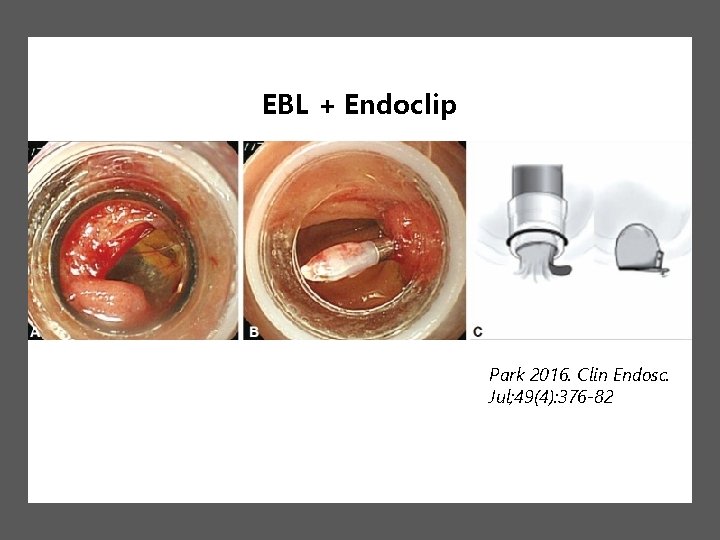 EBL + Endoclip Park 2016. Clin Endosc. Jul; 49(4): 376 -82 EBL + Endoclip Park 2016. Clin Endosc. Jul; 49(4): 376 -82