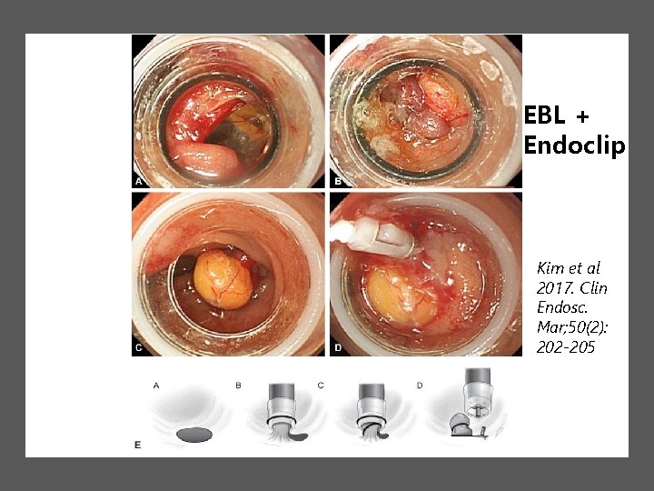 EBL + Endoclip Kim et al 2017. Clin Endosc. Mar; 50(2): 202 -205 EBL + Endoclip Kim et al 2017. Clin Endosc. Mar; 50(2): 202 -205