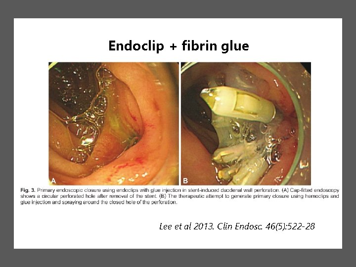 Endoclip + fibrin glue Lee et al 2013. Clin Endosc. 46(5): 522 -28 Endoclip + fibrin glue Lee et al 2013. Clin Endosc. 46(5): 522 -28