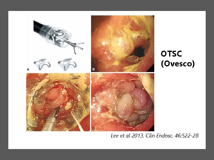 OTSC (Ovesco) Lee et al 2013. Clin Endosc. 46: 522 -28 OTSC (Ovesco) Lee et al 2013. Clin Endosc. 46: 522 -28