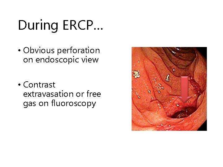 During ERCP… • Obvious perforation on endoscopic view • Contrast extravasation or free gas During ERCP… • Obvious perforation on endoscopic view • Contrast extravasation or free gas