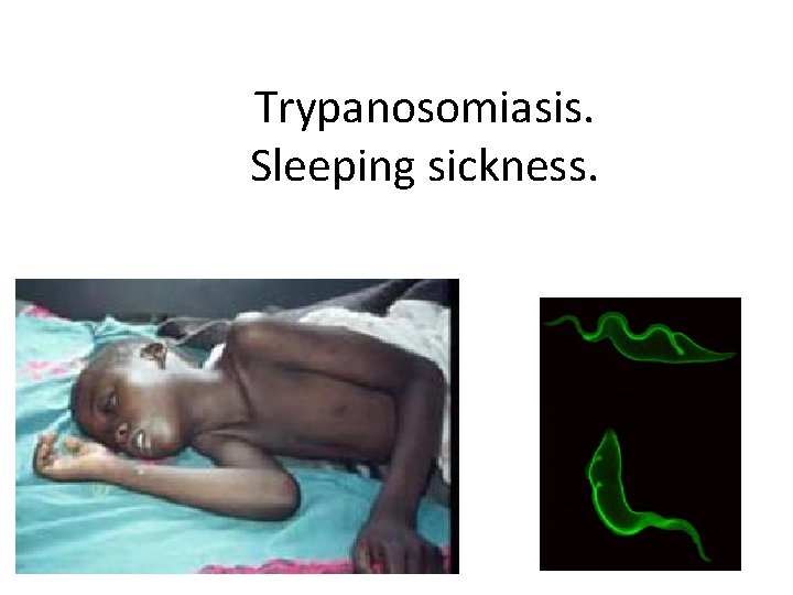 Trypanosomiasis. Sleeping sickness. 