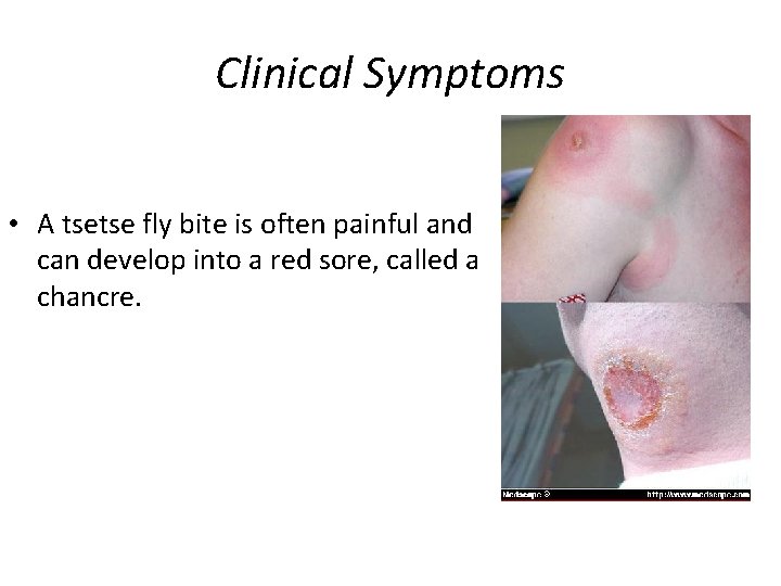 Clinical Symptoms • A tsetse fly bite is often painful and can develop into
