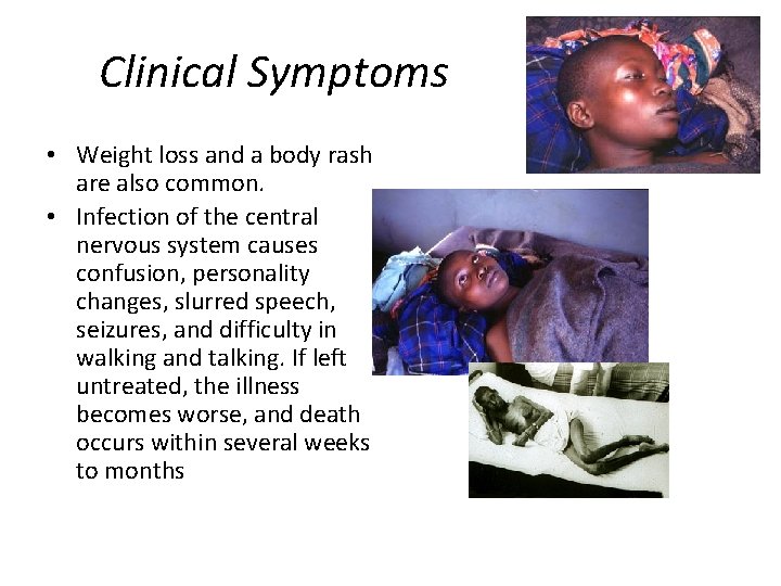 Clinical Symptoms • Weight loss and a body rash are also common. • Infection