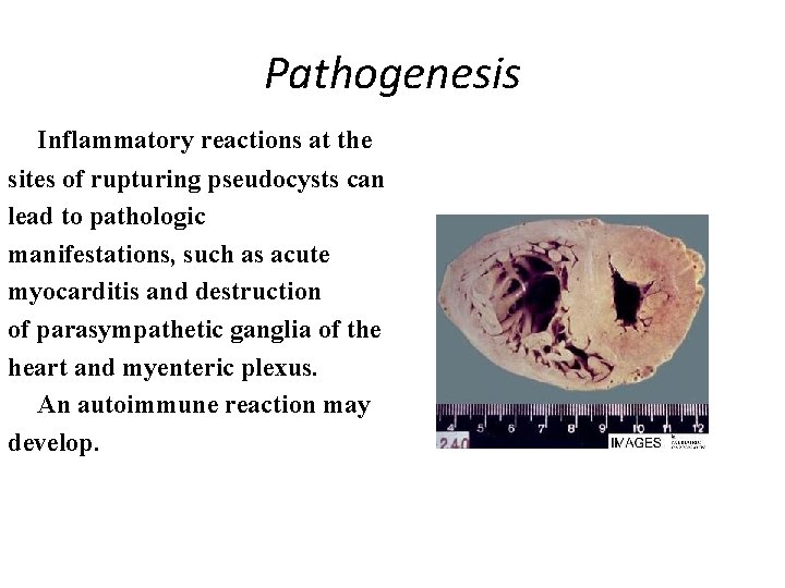 Pathogenesis Inflammatory reactions at the sites of rupturing pseudocysts can lead to pathologic manifestations,