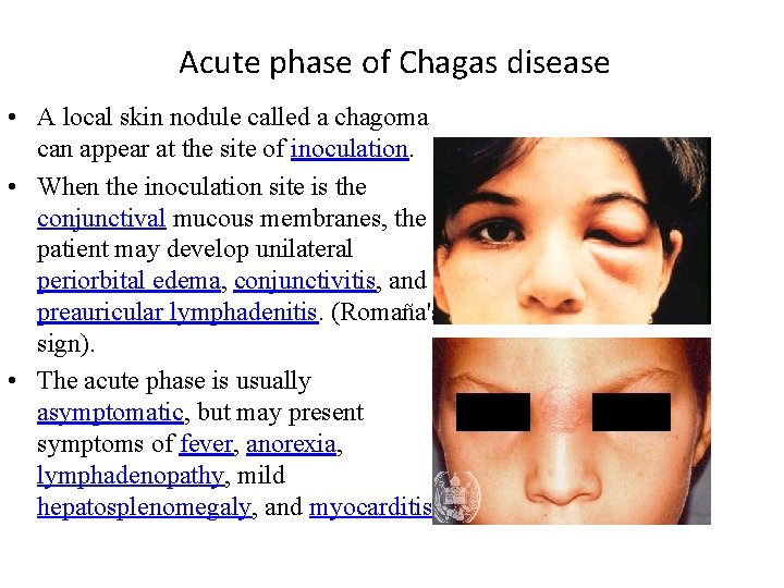Acute phase of Chagas disease • A local skin nodule called a chagoma can