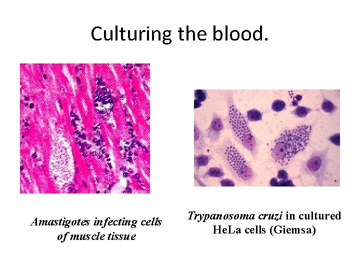 Culturing the blood. Amastigotes infecting cells of muscle tissue Trypanosoma cruzi in cultured He.