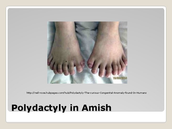 http: //nell-rose. hubpages. com/hub/Polydactyly-The-curious-Congenital-Anomaly-found-In-Humans Polydactyly in Amish http: //nell-rose. hubpages. com/hub/Polydactyly-The-curious-Congenital-Anomaly-found-In-Humans Polydactyly in Amish