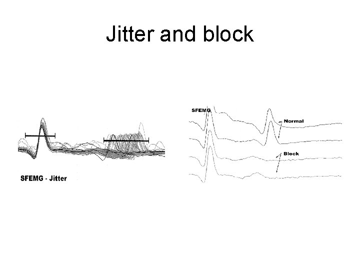 Jitter and block 